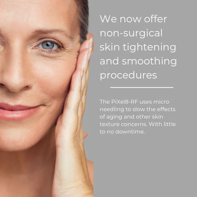 RF Microneedling treatment