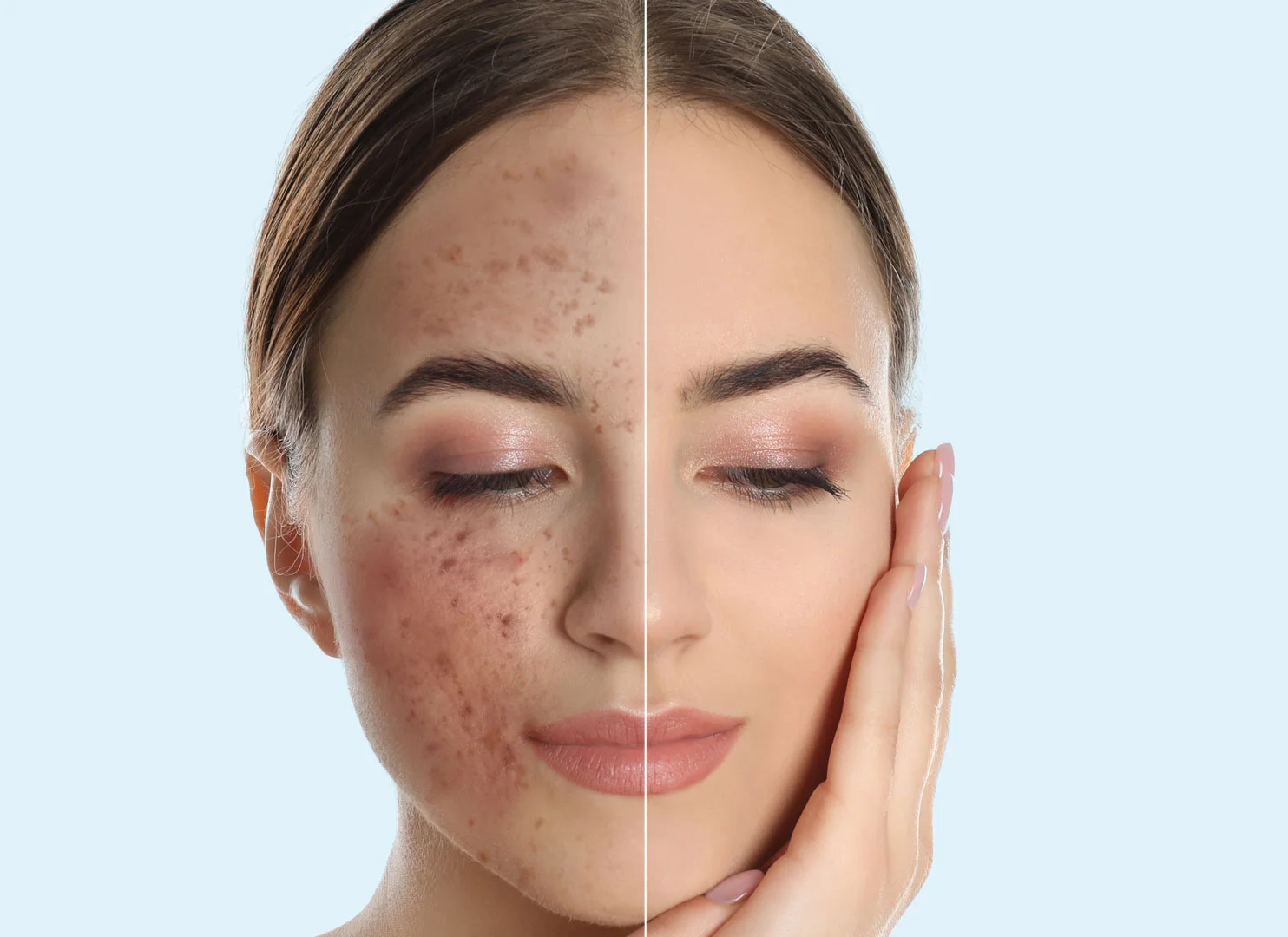 Before and after RF microneedling results