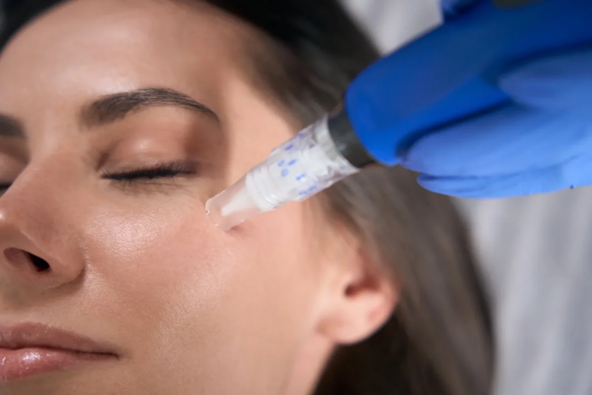 RF Microneedling