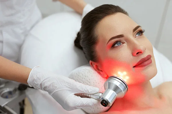 Laser (Acne) treatment